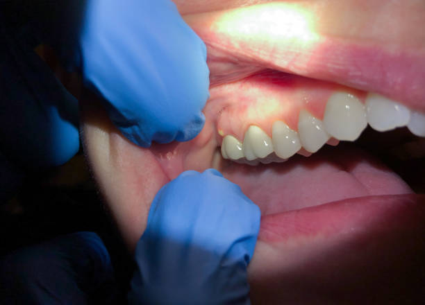 Best Broken Tooth Emergency  in Pleasantville, IA